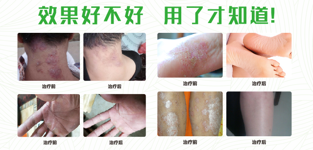 香蕉视频免费真菌清噴劑